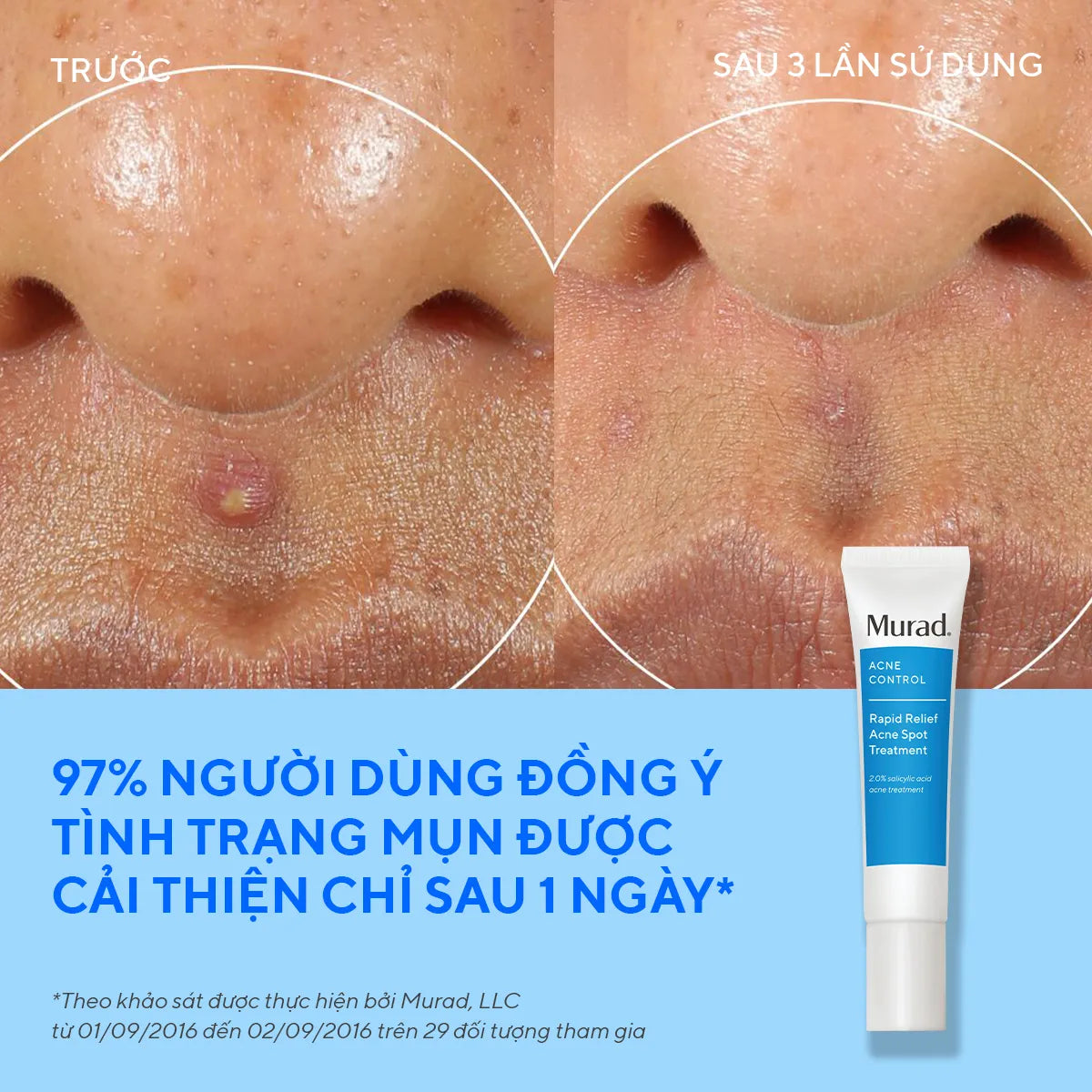 Gel Chấm Mụn Giảm Sưng Viêm Murad Rapid Relief Acne Treatment 15ml