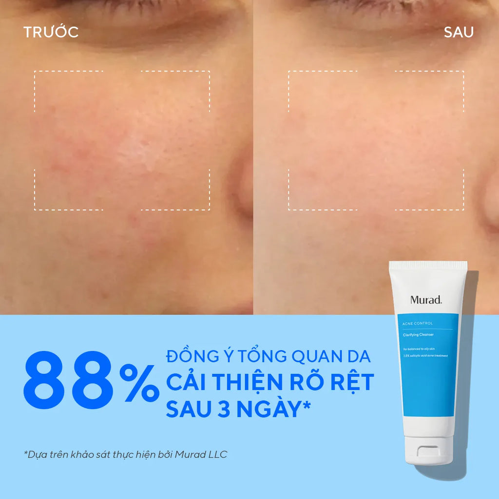 Sữa Rửa Mặt Gel Làm Sạch & Ngừa Mụn Murad Clarifying Cleanser (148ml)