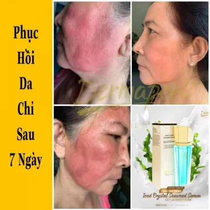 Serum Tinh Tảo Băng Dermapeel 100ml