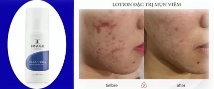 Lotion Giảm Mụn Image Skincare Clear Cell Medicated Acne Lotion